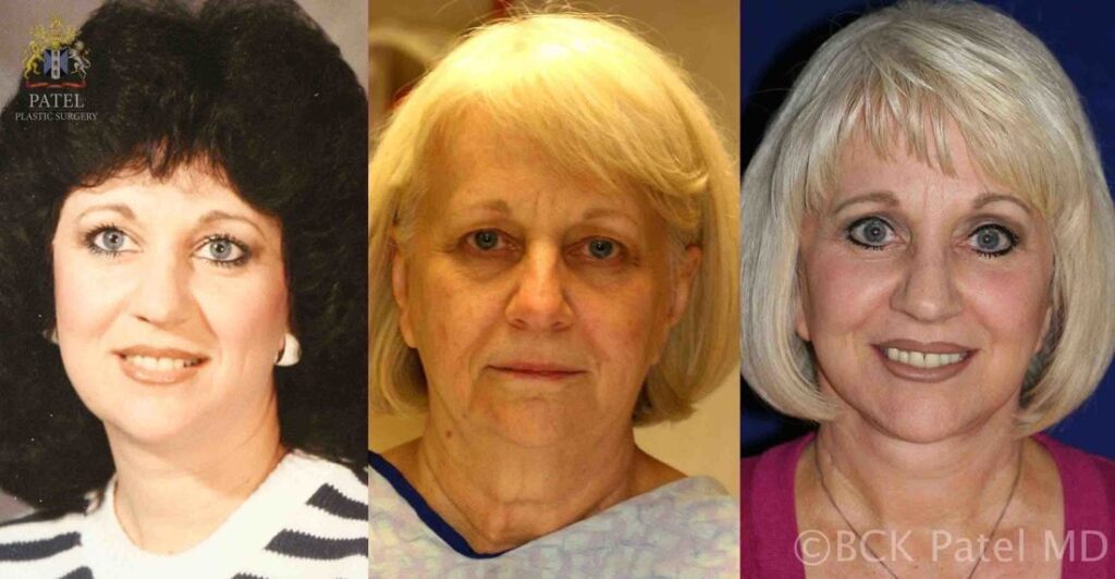 Facelift and necklift giving a beautiful result; Surgery by Dr. BCK Patel MD, FRCS, Salt Lake City, Patel Plastic Surgery