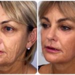 Thread lift by Dr BCK Patel MD, FRCS