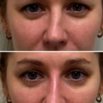 Thread lift by Dr BCK Patel MD, FRCS