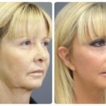 Thread lift by Dr BCK Patel MD, FRCS