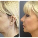 Thread lift by Dr BCK Patel MD, FRCS