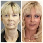 Thread lift by Dr BCK Patel MD, FRCS