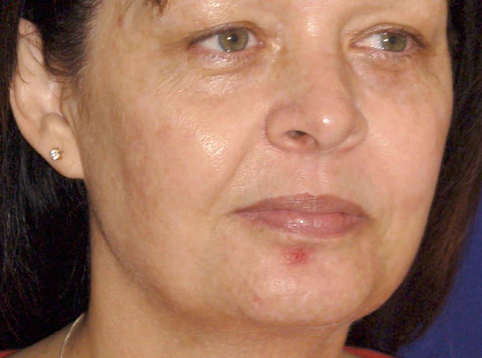 The power of lasers. Using advanced lasers of different wavelengths allows improvement in redness, brown spots, pores, fine lines and even gives some skin tightening. By Dr. BCK Patel MD, FRCS of patelplasticsurgery.com of Salt Lake City and St. George, Utah
