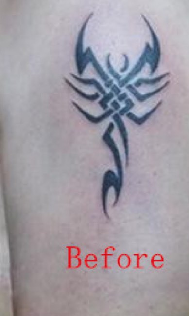 Tatto removal with advanced lasers by Dr. BCK Patel MD, FRCS of patelplasticsurgery.com of Salt Lake City and St. George, Utah