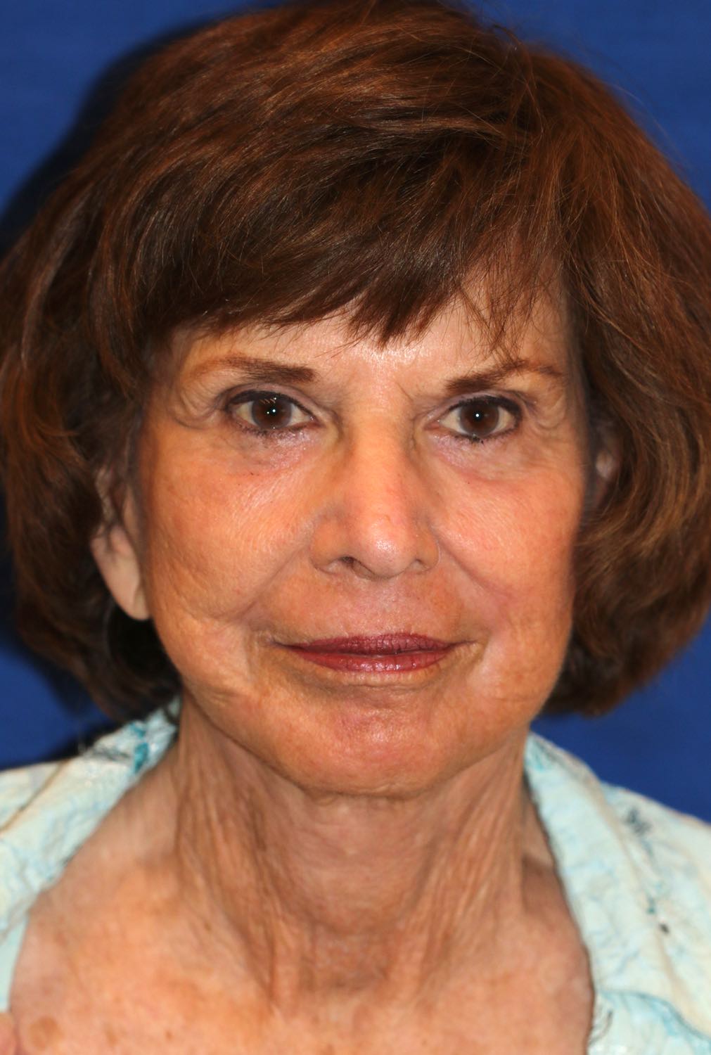 Facelift and Necklift together with the use of nanofatgrafts and fractionated CO2 laser for the rejuvenation of the face, jawline, jowls, neck, lips, lip lines and perioral region by Dr. BCK Patel MD before and after photos Salt Lake City, St George of patelplasticsurgery.com