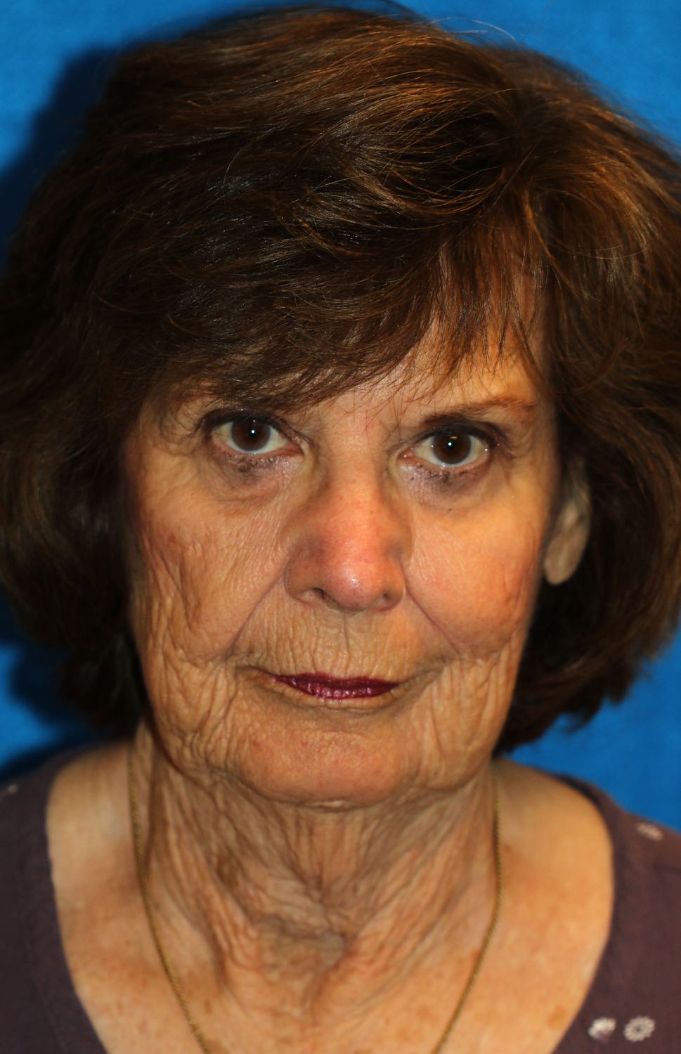 Facelift and Necklift together with the use of nanofatgrafts and fractionated CO2 laser for the rejuvenation of the face, jawline, jowls, neck, lips, lip lines and perioral region by Dr. BCK Patel MD before and after photos Salt Lake City, St George of patelplasticsurgery.com